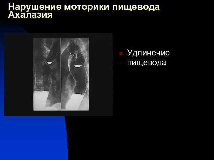 Нарушение моторики пищевода Ахалазия n Удлинение пищевода 