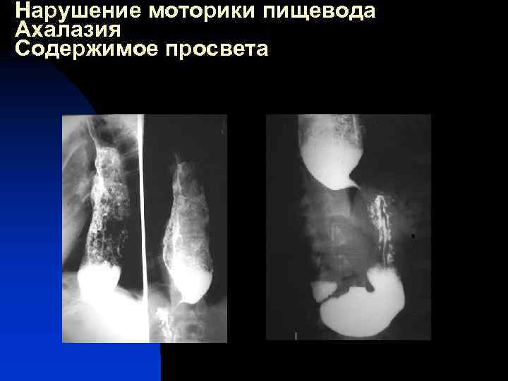Нарушение моторики пищевода Ахалазия Содержимое просвета 