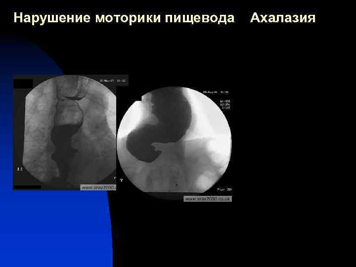 Нарушение моторики пищевода Ахалазия 