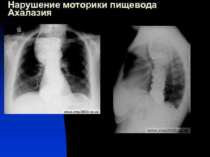 Нарушение моторики пищевода Ахалазия 