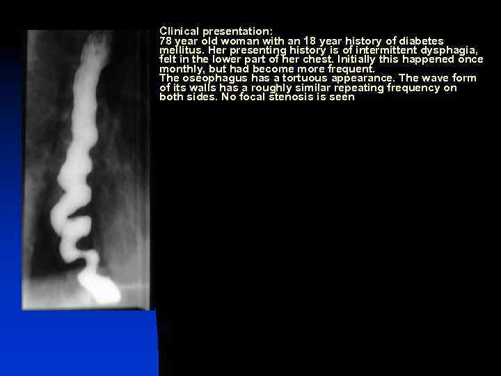 Clinical presentation: 78 year old woman with an 18 year history of diabetes mellitus.