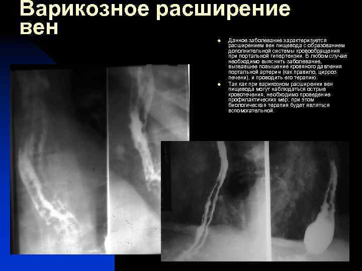 Варикозное расширение вен u u Данное заболевание характеризуется расширением вен пищевода с образованием дополнительной