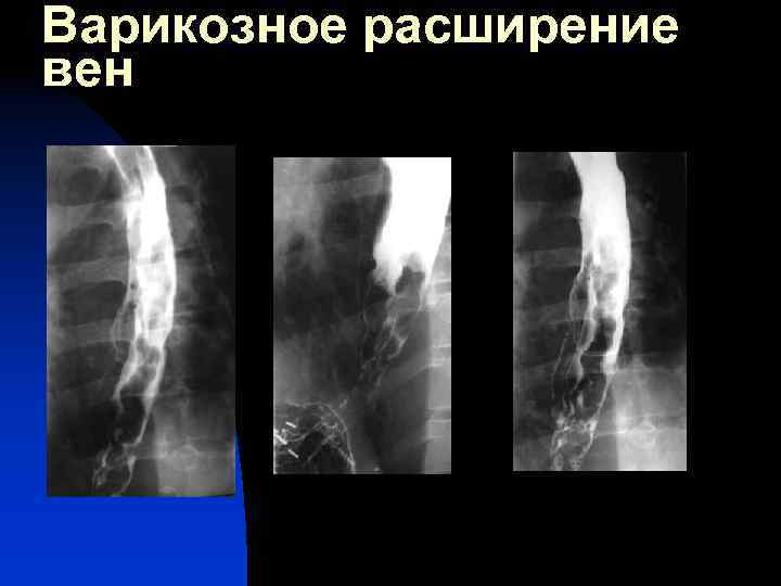 Варикозное расширение вен 