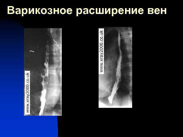 Варикозное расширение вен 