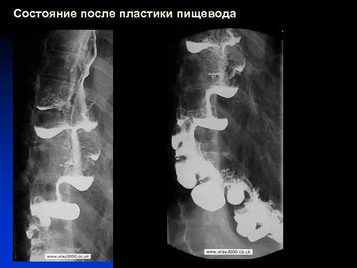 Состояние после пластики пищевода 