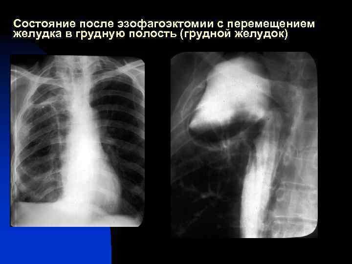 Состояние после эзофагоэктомии с перемещением желудка в грудную полость (грудной желудок) 