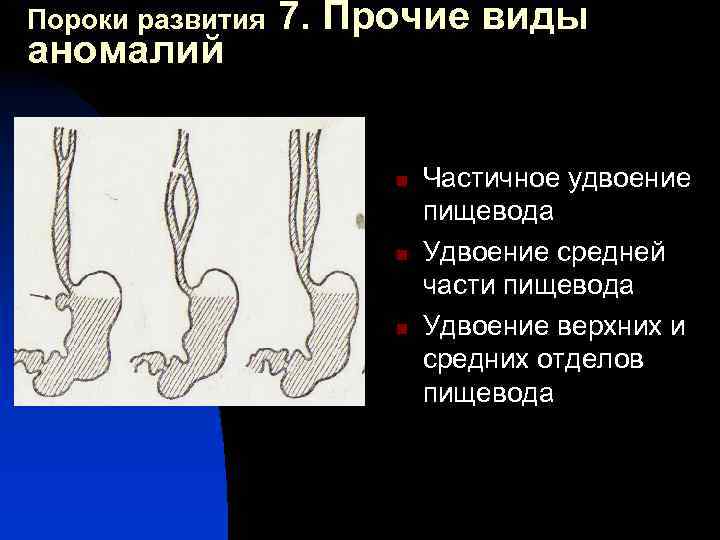 Развитие желудка. Врожденные аномалии развития пищевода. Пороки развития пищевода хирургия. Заболевания и пороки развития пищевода у детей. Аномалии развития пищевода у детей.