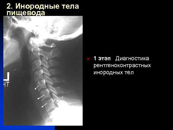 Мрт инородное тело