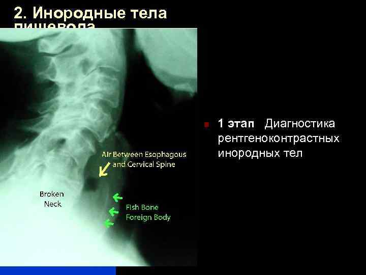 Инородное тело пищевода карта вызова скорой медицинской