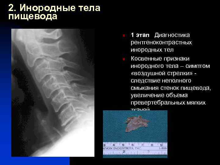 Инородное тело пищевода карта вызова скорой медицинской помощи