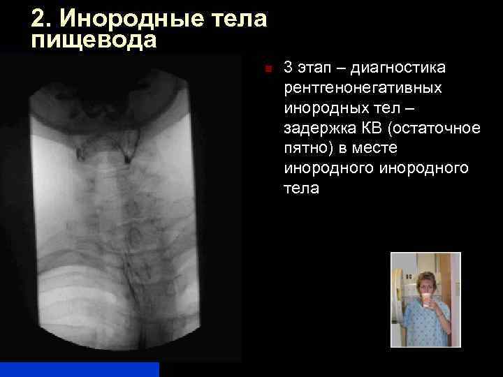 2. Инородные тела пищевода n 3 этап – диагностика рентгенонегативных инородных тел – задержка