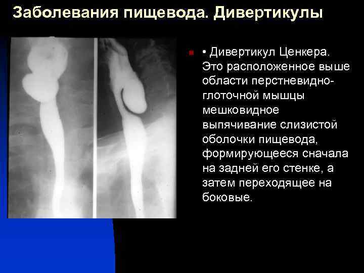 Лучевая диагностика пищевода презентация