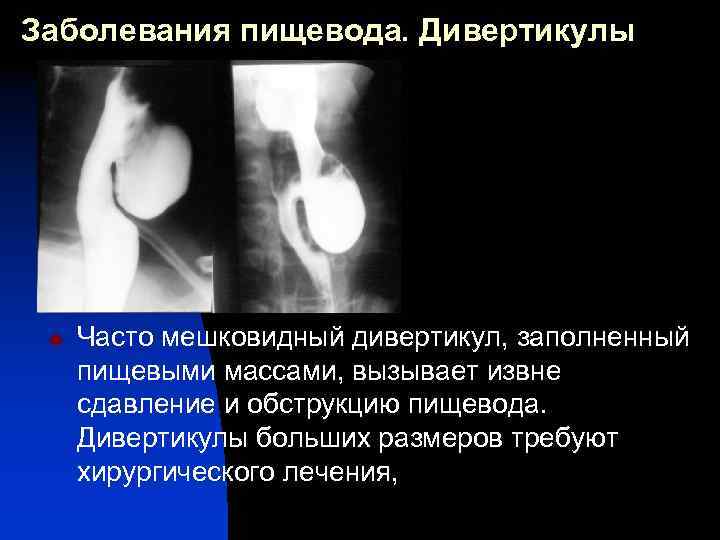 Лучевая диагностика заболеваний пищевода презентация