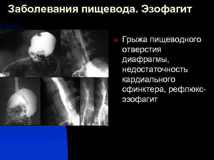 Лучевая диагностика заболеваний пищевода презентация