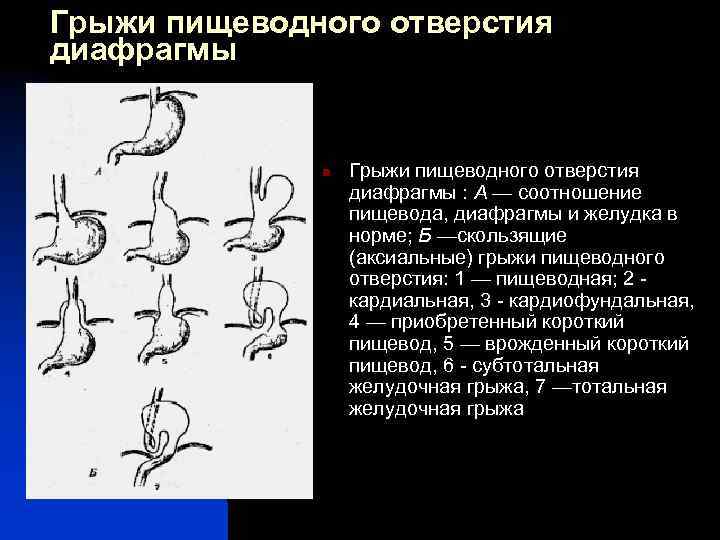 Эндоскопическая картина при грыжах пищеводного отверстия диафрагмы характеризуется