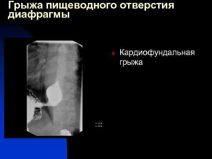 Лучевая диагностика заболеваний пищевода презентация