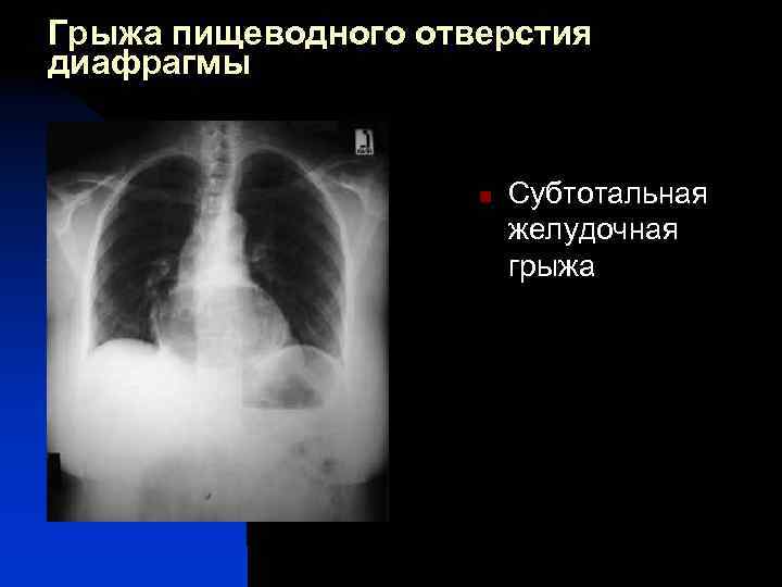 Грыжа пищеводного отверстия диафрагмы n Субтотальная желудочная грыжа 