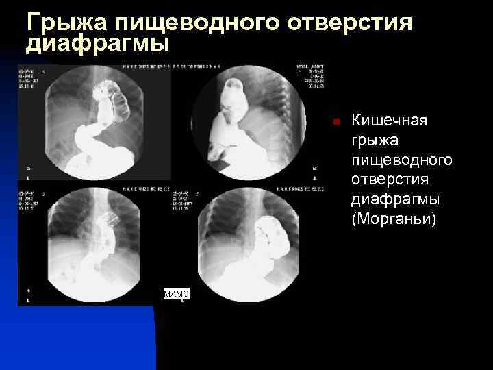 Грыжа пищеводного отверстия диафрагмы n Кишечная грыжа пищеводного отверстия диафрагмы (Морганьи) 