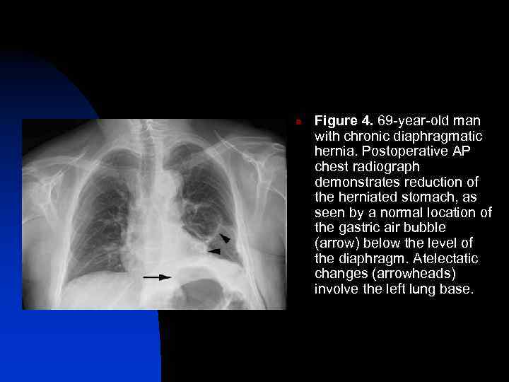n Figure 4. 69 -year-old man with chronic diaphragmatic hernia. Postoperative AP chest radiograph