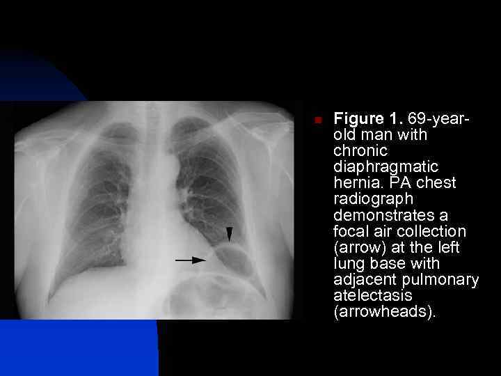 n Figure 1. 69 -yearold man with chronic diaphragmatic hernia. PA chest radiograph demonstrates