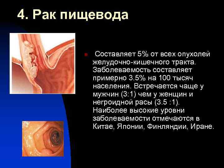 Операция льюиса при раке пищевода жизнь после последствия