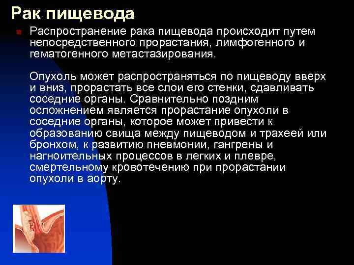 Операция льюиса при раке пищевода жизнь после последствия