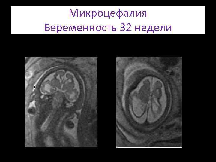 Микроцефалия Беременность 32 недели 