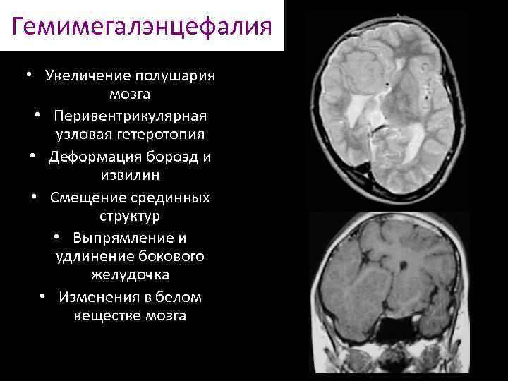 Железы монтгомери у небеременных фото