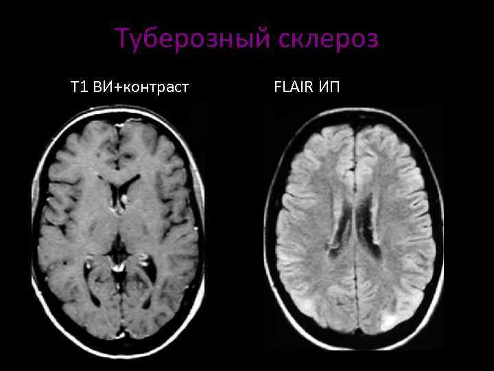 Туберозный склероз. Туберкулезный склероз головного мозга. Тубулярный склероз головного мозга. Туберозный склероз мозга. Болезнь Бурневилля мрт.