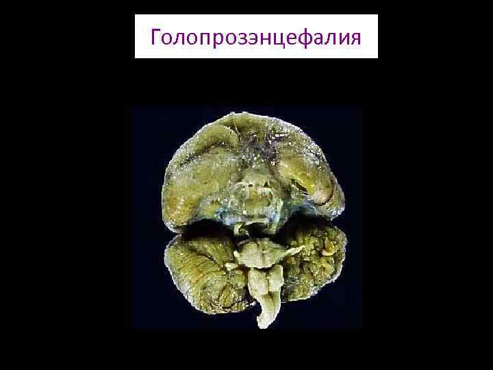 Голопрозэнцефалия 