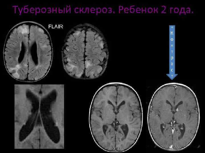 Туберозный склероз презентация