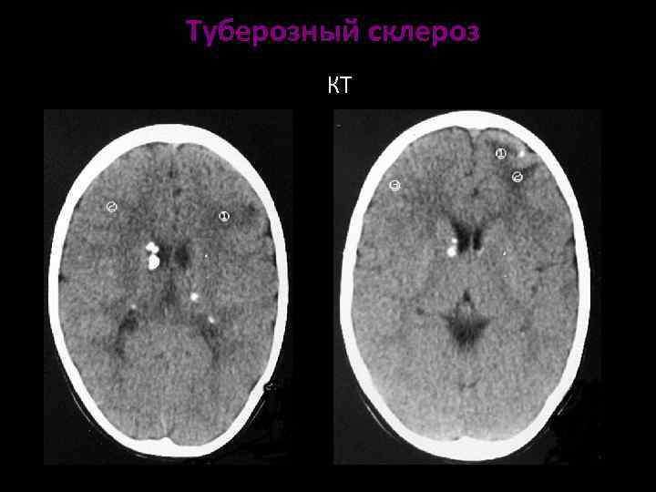 Туберозный склероз презентация