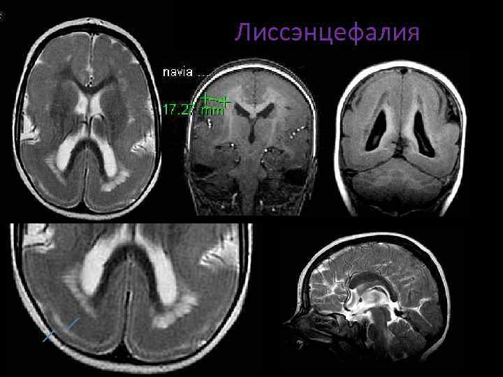 Пахигирия. Лиссэнцефалия-пахигирия. Неполная лиссэнцефалия. Лиссэнцефалия головного мозга у плода. Лиссэнцефалия кт.