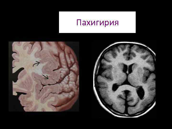 Расширение наружных ликворных пространств у детей. Лиссэнцефалия-пахигирия. Расширение наружных ликворных пространств. Расширение ликворных пространств головного мозга.