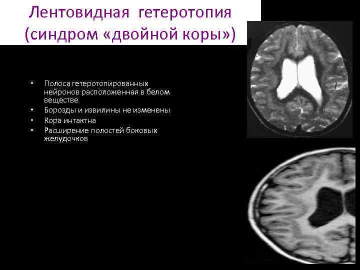 Гетеротопия. Лентовидная гетеротопия. Лентовидная гетеротопия серого вещества. Гетеротопия коры это.