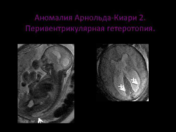 Аномалия арнольда киари операция