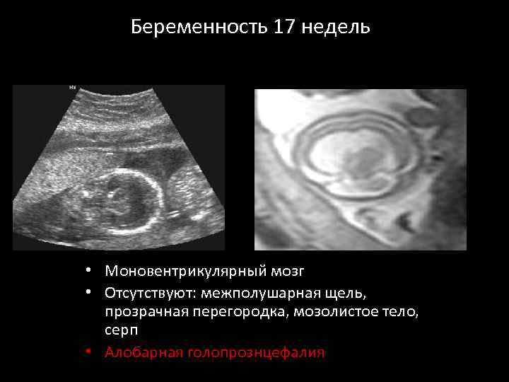 Беременность 17 недель • Моновентрикулярный мозг • Отсутствуют: межполушарная щель, прозрачная перегородка, мозолистое тело,