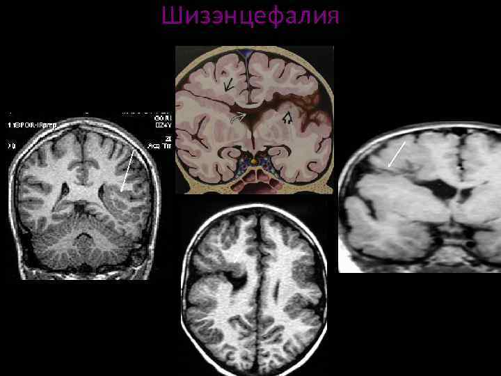 Шизэнцефалия мрт картинки