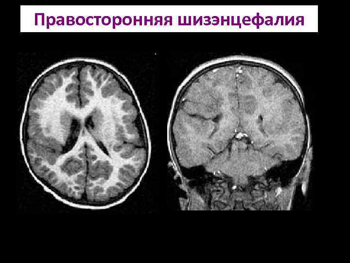 Шизэнцефалия мрт картинки