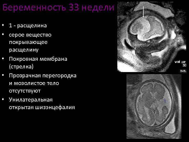 Беременность 33 недели • 1 - расщелина • серое вещество покрывающее расщелину • Покровная