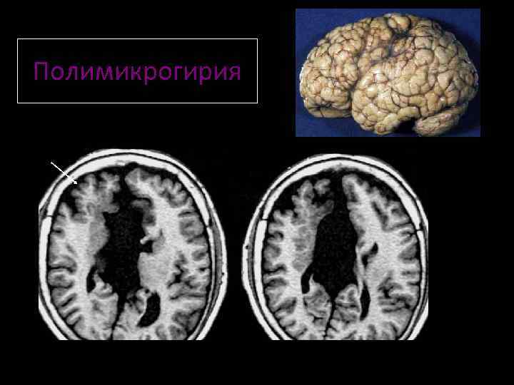 Пахигирия. Лиссэнцефалия-пахигирия. Полимикрогирия лобных долей. Полимикрогирия головного мозга мрт. Перисильвиарная полимикрогирия.