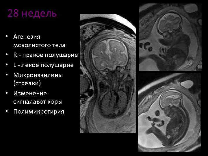 Мозолистое тело картинка