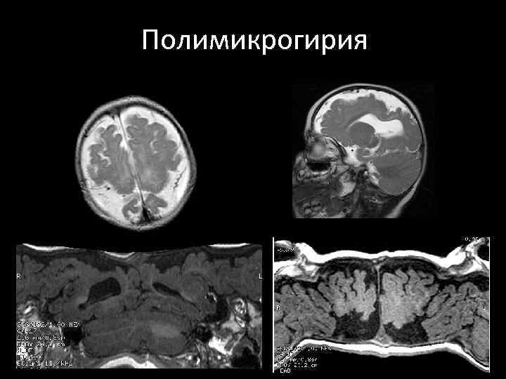 Полимикрогирия 