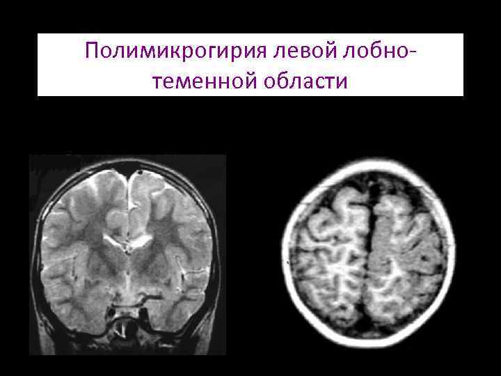 Пахигирия. Порэнцефалическая киста на кт. Полимикрогирия лобных долей. Полимикрогирия мрт.