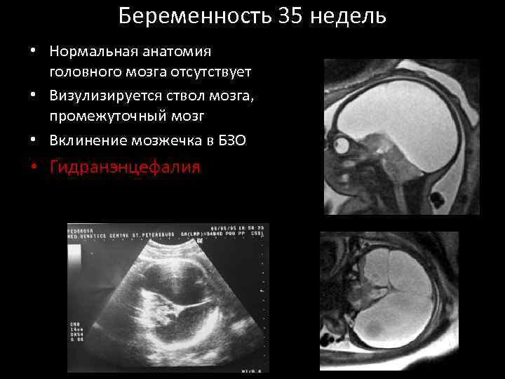Беременность 35 недель • Нормальная анатомия головного мозга отсутствует • Визулизируется ствол мозга, промежуточный