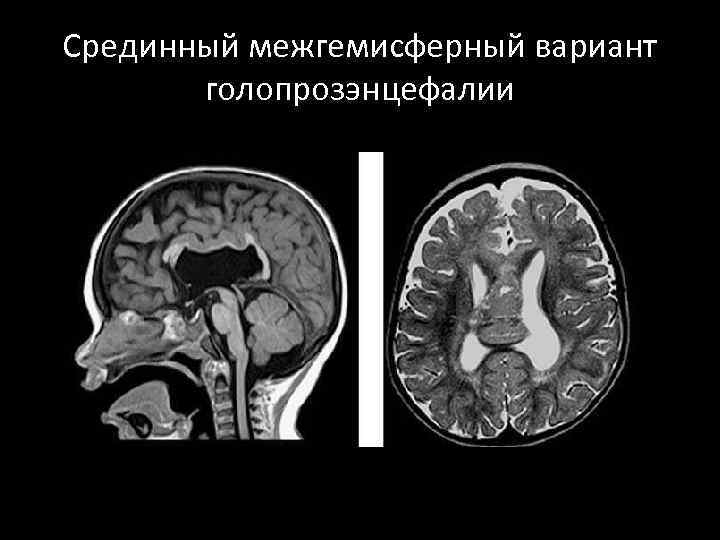 Срединный межгемисферный вариант голопрозэнцефалии 