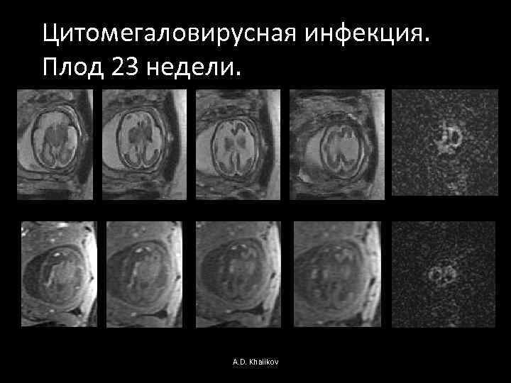 Цитомегаловирусная инфекция. Плод 23 недели. A. D. Khalikov 