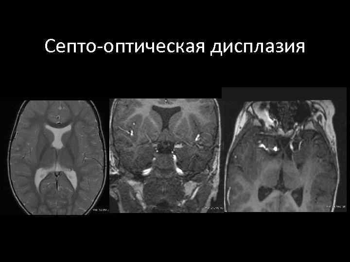 Септо-оптическая дисплазия 