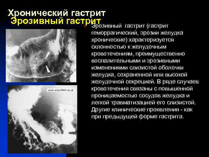 Хронический гастрит Эрозивный n гастрит (гастрит геморрагический, эрозии желудка хронические) характеризуется склонностью к желудочным