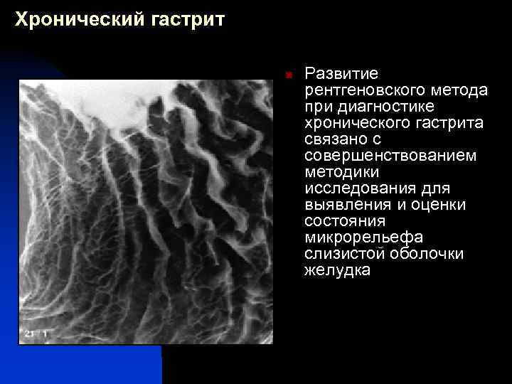 Хронический гастрит n Развитие рентгеновского метода при диагностике хронического гастрита связано с совершенствованием методики